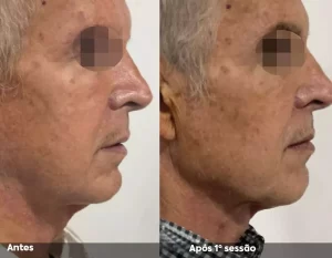Antes e Depois 03
