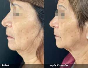 Antes e Depois 06