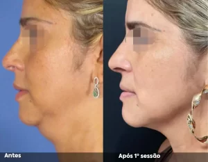 Antes e Depois 04
