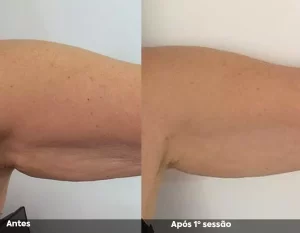 Antes e Depois 02