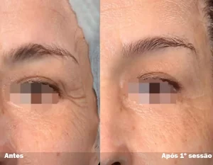 Antes e Depois 01