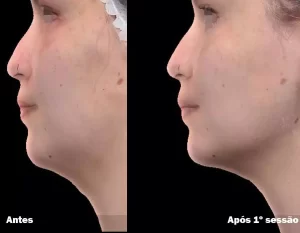 Antes e Depois 05